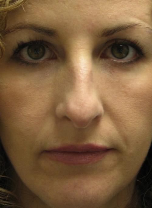 Cosmetic Surgery & Dermatology of Issaquah under-eye filler after — Issaquah, WA