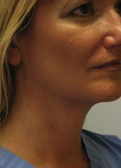 Cosmetic Surgery & Dermatology of Issaquah neck liposuction after — Issaquah, WA
