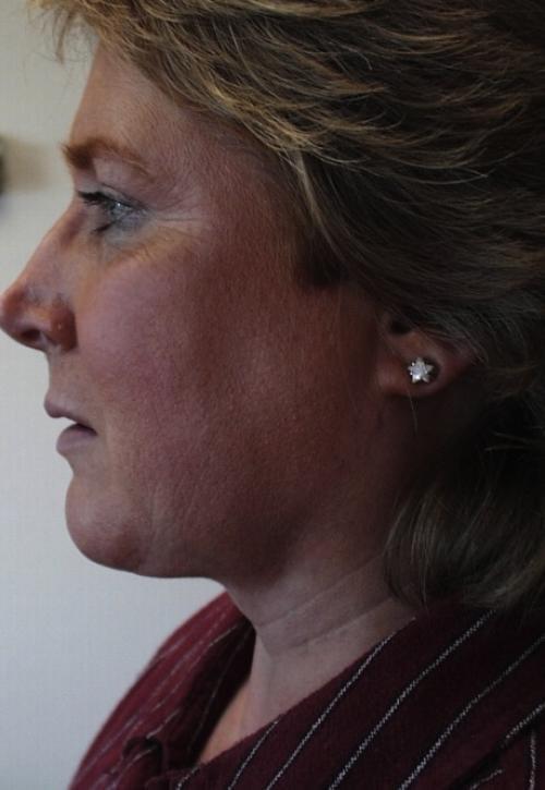 Neck Liposuction after at Cosmetic Surgery & Dermatology of Issaquah in Issaquah, WA