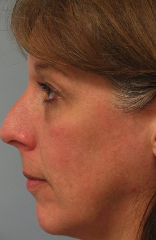 Cosmetic Surgery & Dermatology of Issaquah laser treatment after — Issaquah, WA
