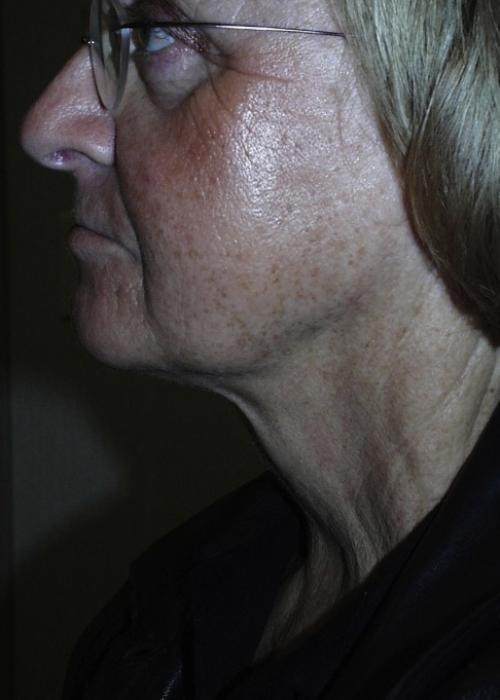 Cosmetic Surgery & Dermatology of Issaquah neck liposuction after — Issaquah, WA