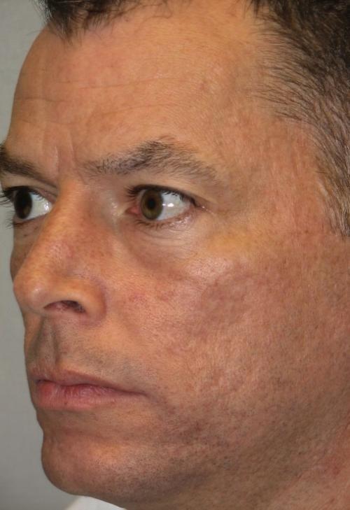 Cosmetic Surgery & Dermatology of Issaquah laser treatment after — Issaquah, WA