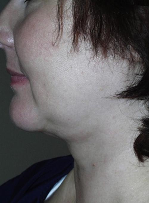 Cosmetic Surgery & Dermatology of Issaquah neck liposuction after — Issaquah, WA