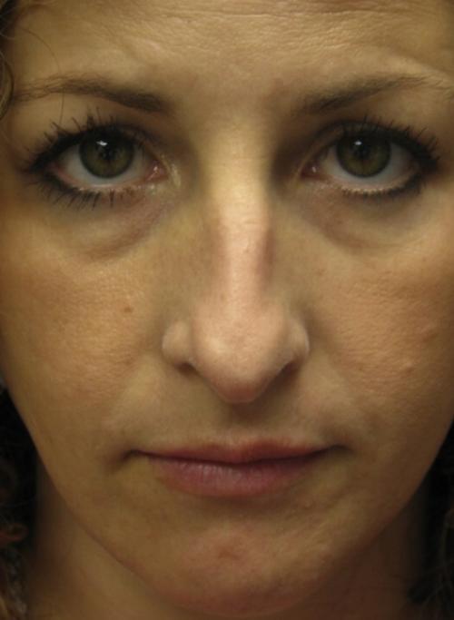 Dermal Fillers before at Cosmetic Surgery & Dermatology of Issaquah in Issaquah, WA