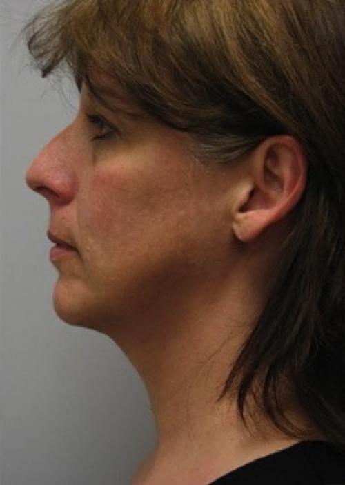 Cosmetic Surgery & Dermatology of Issaquah neck liposuction after — Issaquah, WA
