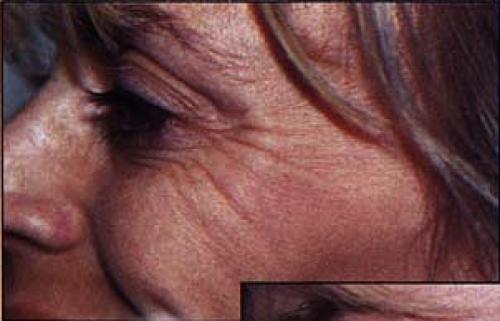 Botox before at Cosmetic Surgery & Dermatology of Issaquah in Issaquah, WA