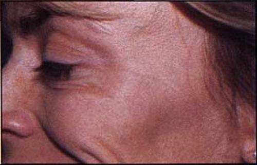 Cosmetic Surgery & Dermatology of Issaquah botox after — Issaquah, WA