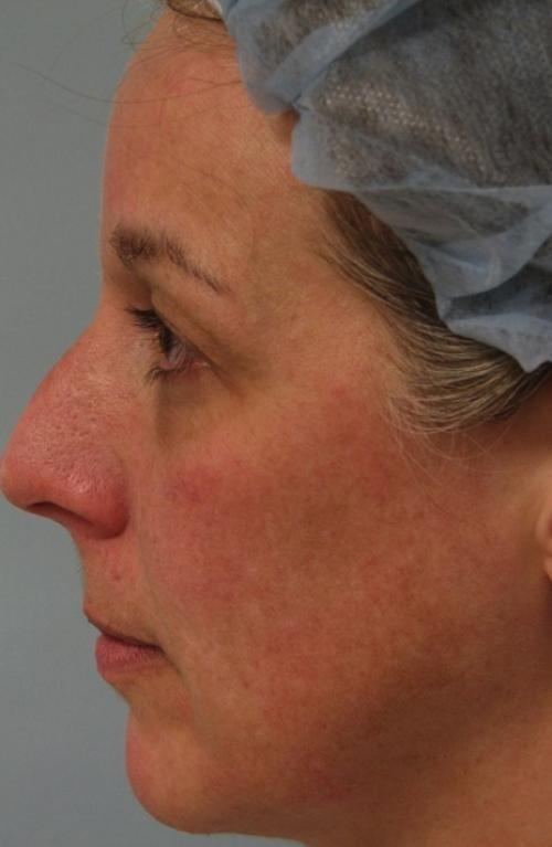 Morpheus8 before at Cosmetic Surgery & Dermatology of Issaquah in Issaquah, WA
