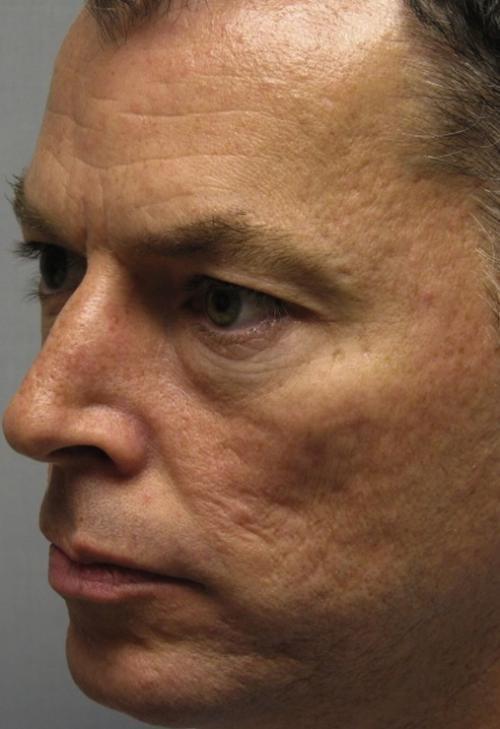 Laser Skin Resurfacing before at Cosmetic Surgery & Dermatology of Issaquah in Issaquah, WA