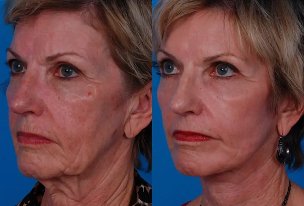 Batniji Facial Plastic Surgery neck lift result — Newport Beach, CA