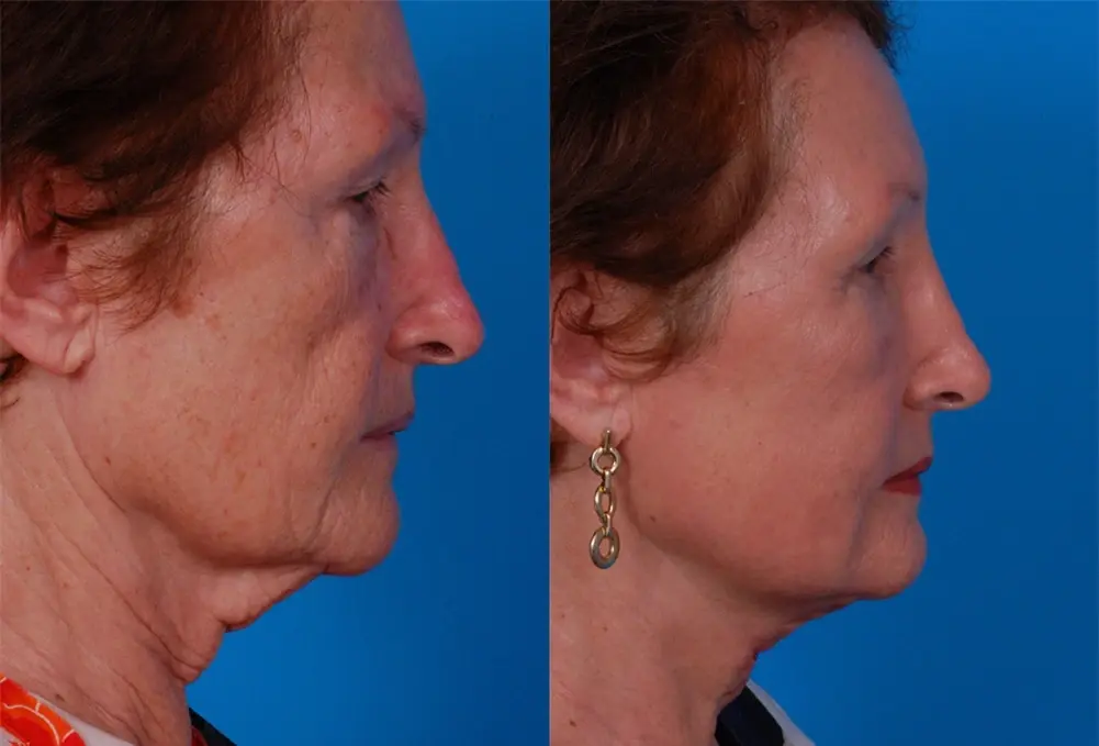 Batniji Facial Plastic Surgery neck lift result — Newport Beach, CA