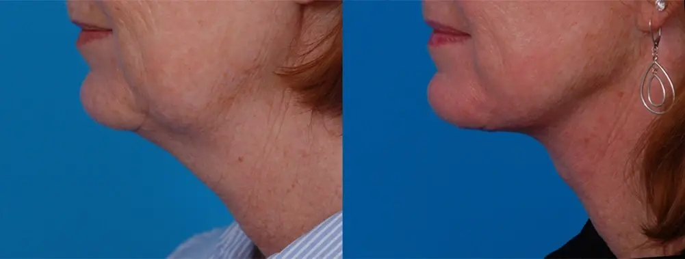 Batniji Facial Plastic Surgery facelift result — Newport Beach, CA