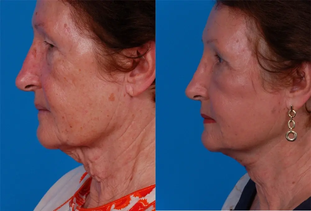 Batniji Facial Plastic Surgery neck lift result — Newport Beach, CA