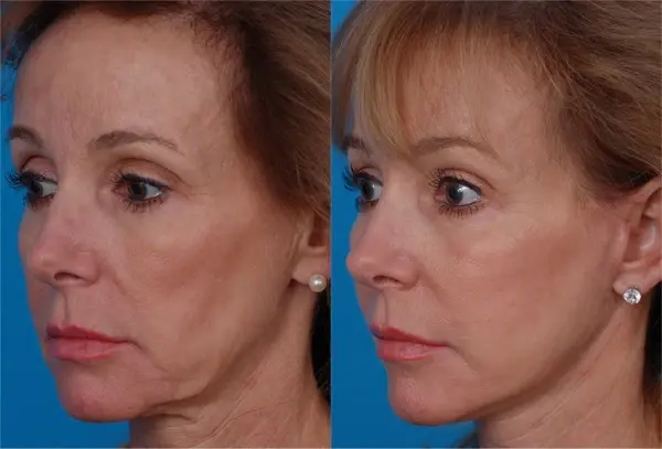 Batniji Facial Plastic Surgery facelift result — Newport Beach, CA