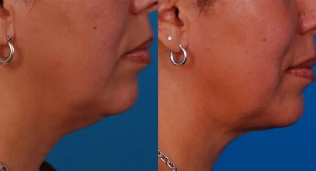 Neck Liposuction result at Batniji Facial Plastic Surgery in Newport Beach, CA