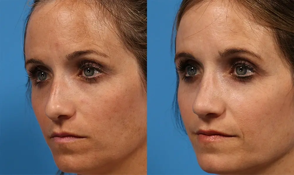 Batniji Facial Plastic Surgery rhinoplasty result — Newport Beach, CA