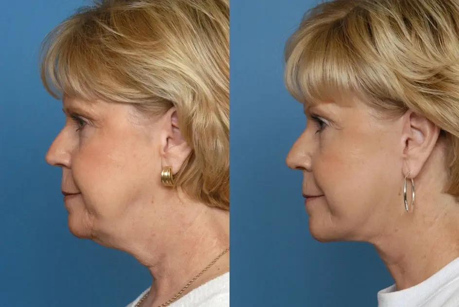 Batniji Facial Plastic Surgery facelift result — Newport Beach, CA