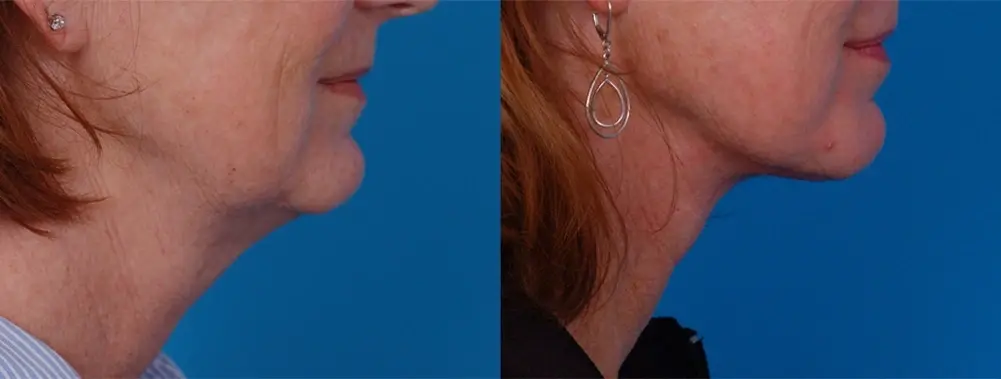 Batniji Facial Plastic Surgery facelift result — Newport Beach, CA