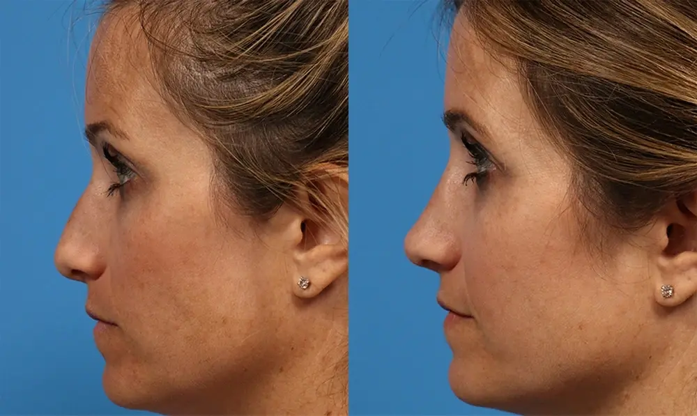 Batniji Facial Plastic Surgery rhinoplasty result — Newport Beach, CA
