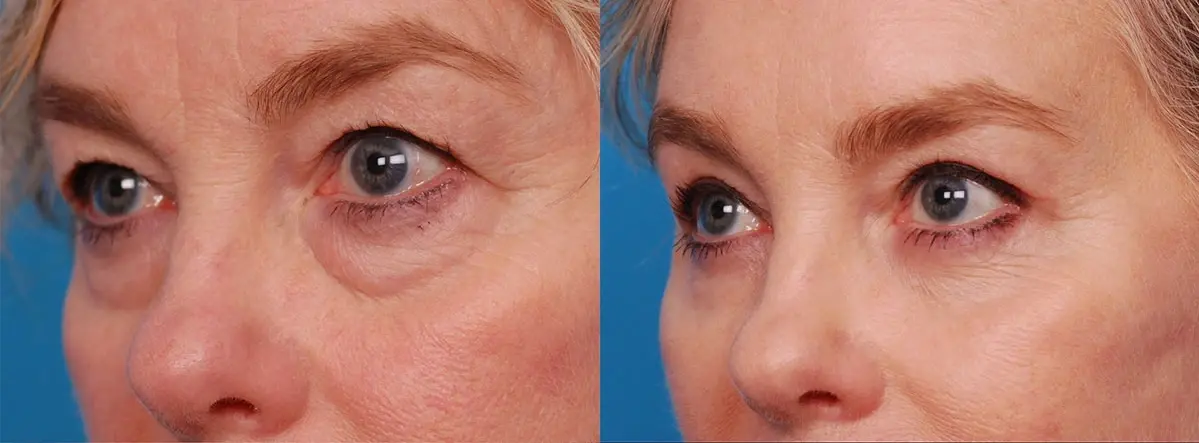Batniji Facial Plastic Surgery blepharoplasty result — Newport Beach, CA