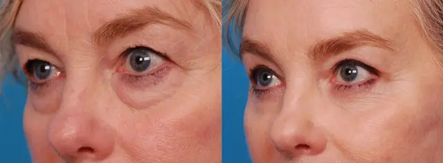 Blepharoplasty result at Batniji Facial Plastic Surgery in Newport Beach, CA