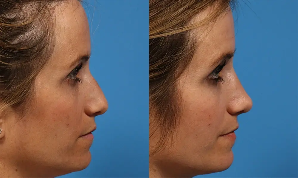 Batniji Facial Plastic Surgery rhinoplasty result — Newport Beach, CA