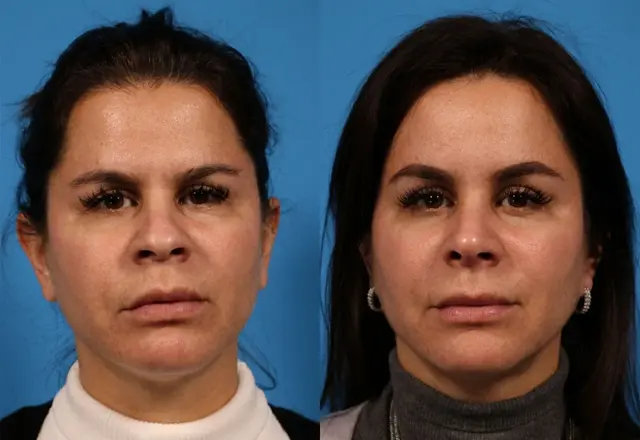 Brow Lift result at Batniji Facial Plastic Surgery in Newport Beach, CA