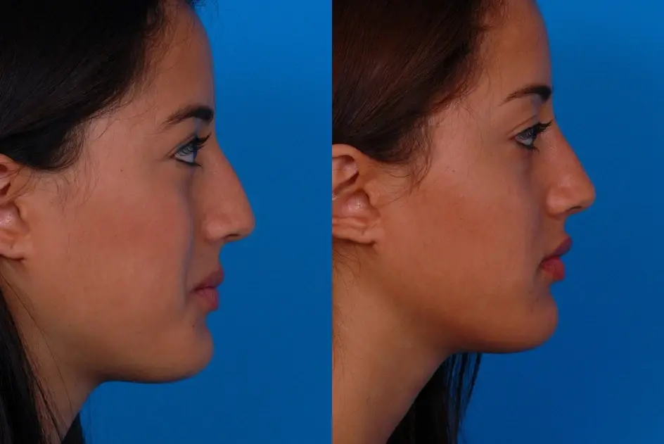 Batniji Facial Plastic Surgery rhinoplasty result — Newport Beach, CA