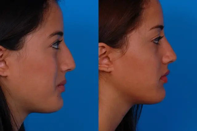 Functional Rhinoplasty result at Batniji Facial Plastic Surgery in Newport Beach, CA