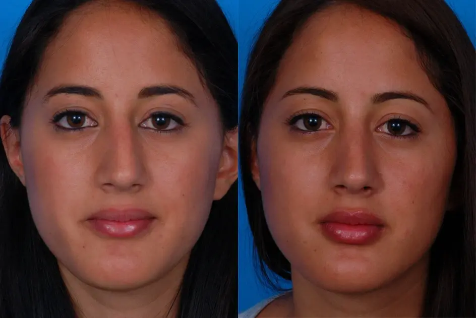 Batniji Facial Plastic Surgery rhinoplasty result — Newport Beach, CA