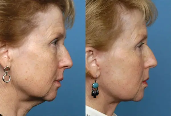 Batniji Facial Plastic Surgery neck lift result — Newport Beach, CA