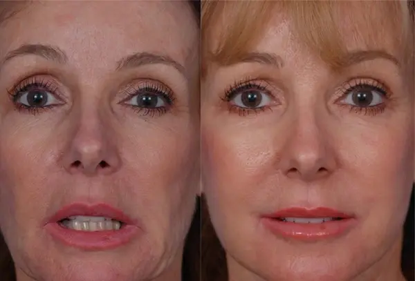 Batniji Facial Plastic Surgery facelift result — Newport Beach, CA