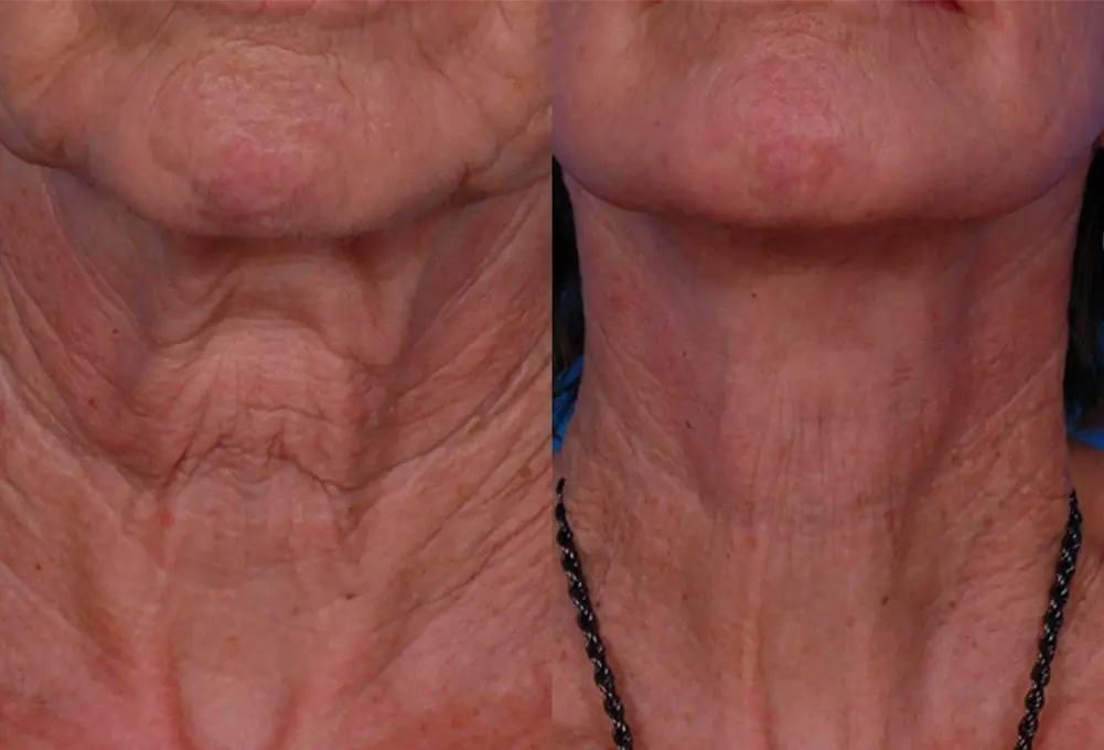 Batniji Facial Plastic Surgery neck lift result — Newport Beach, CA