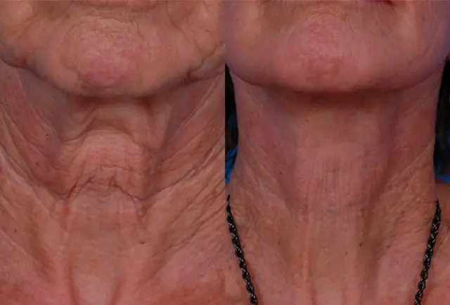 Neck Lift result at Batniji Facial Plastic Surgery in Newport Beach, CA