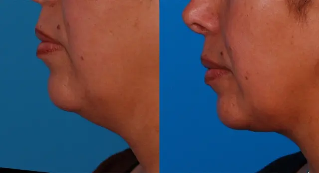 Neck Liposuction result at Batniji Facial Plastic Surgery in Newport Beach, CA