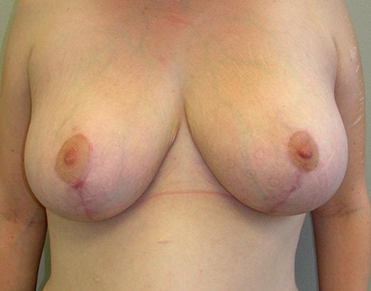 Wendell G. Miles, MD breast reduction after — Chevy Chase, MD