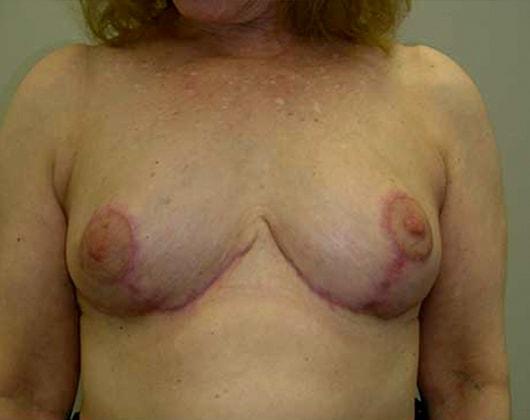Wendell G. Miles, MD breast reduction after — Chevy Chase, MD