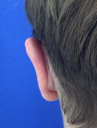 Wendell G. Miles, MD ear pinning after — Chevy Chase, MD