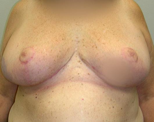 Wendell G. Miles, MD breast reduction after — Chevy Chase, MD