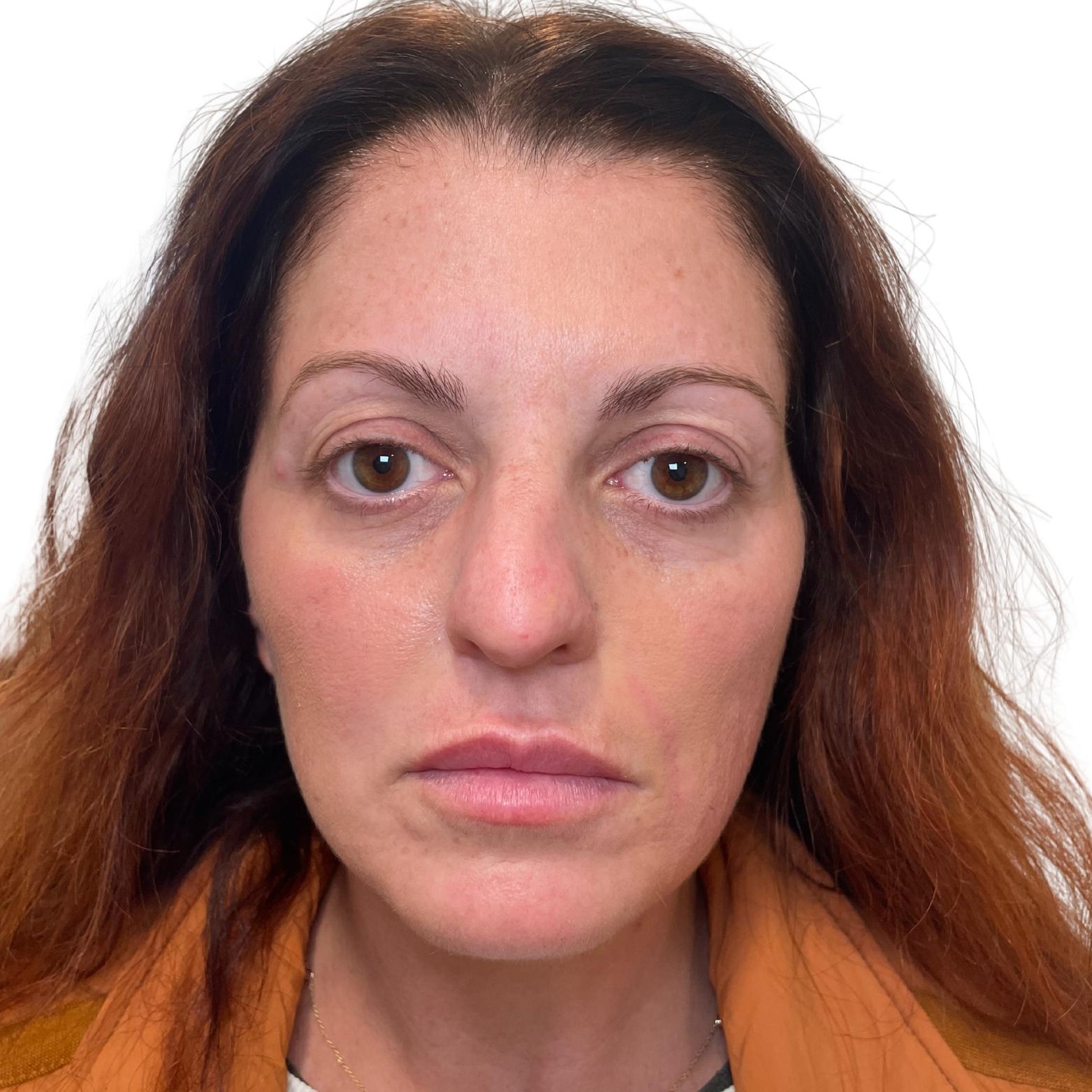 Stages Skin Studio chin implant after — Brentwood, TN