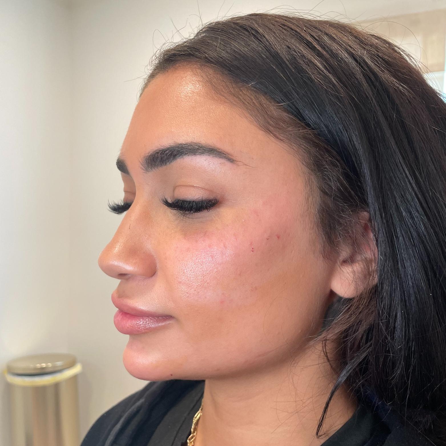 Stages Skin Studio chin implant after — Brentwood, TN
