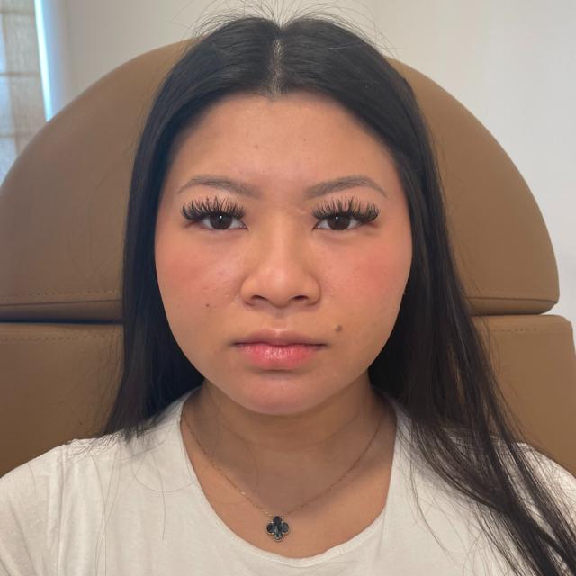 Chin Implant after at Stages Skin Studio in Brentwood, TN