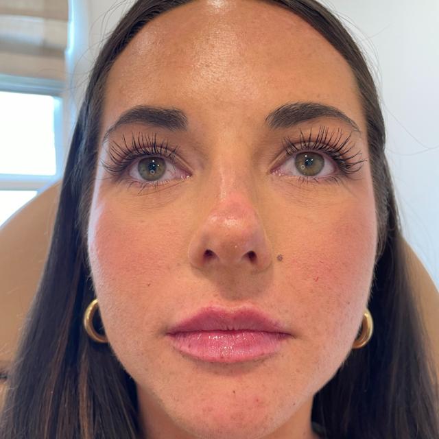 Lip Filler after at Stages Skin Studio in Brentwood, TN