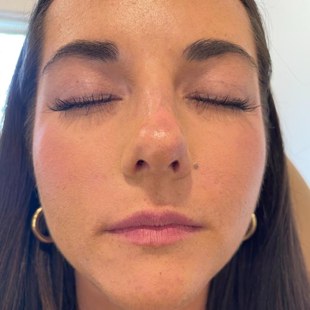 Lip Filler before at Stages Skin Studio in Brentwood, TN