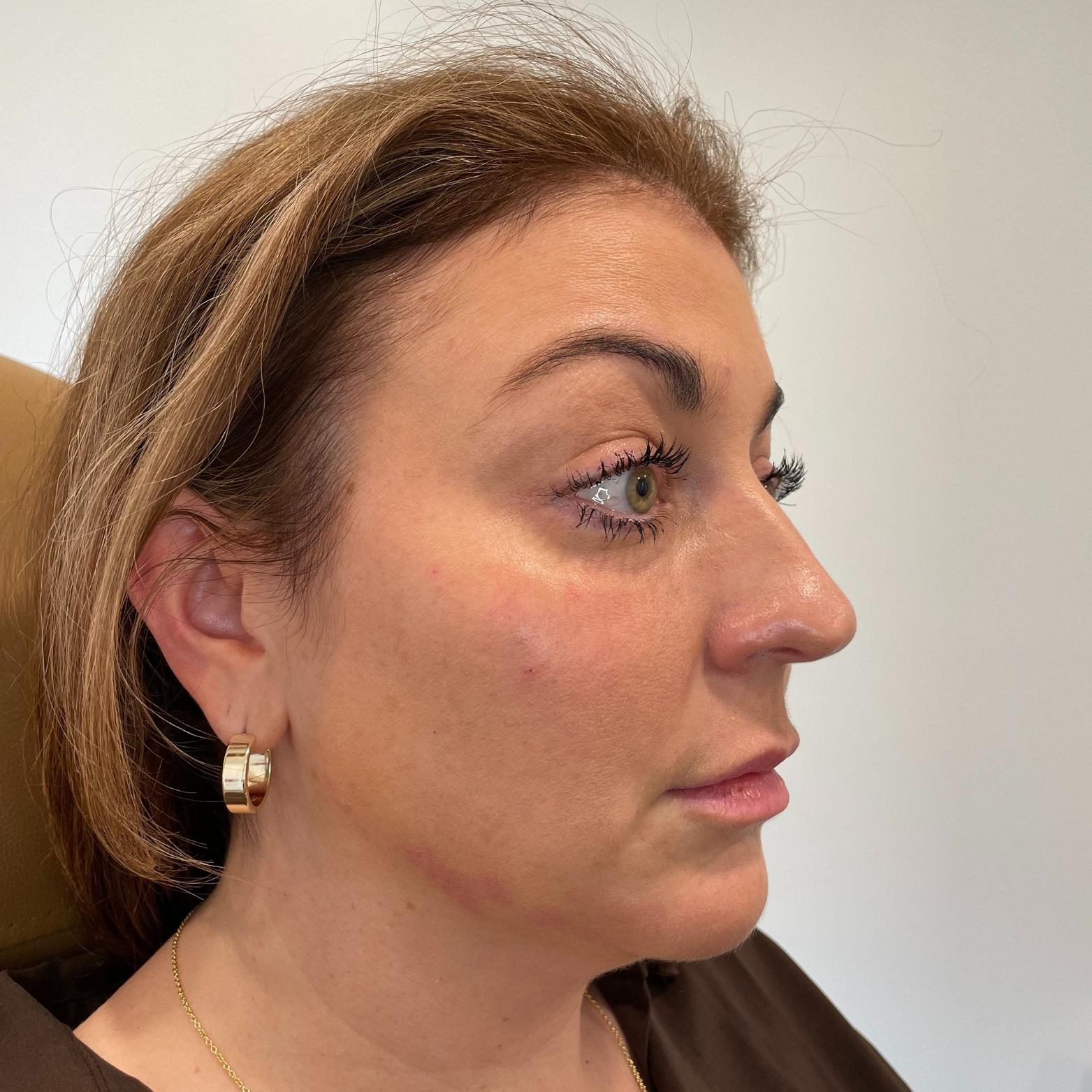 Stages Skin Studio chin implant after — Brentwood, TN