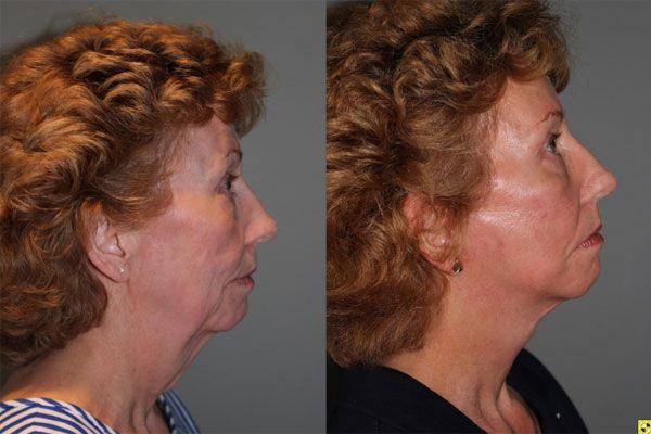 Kalos Facial Plastic Surgery facelift result — Alpharetta, GA