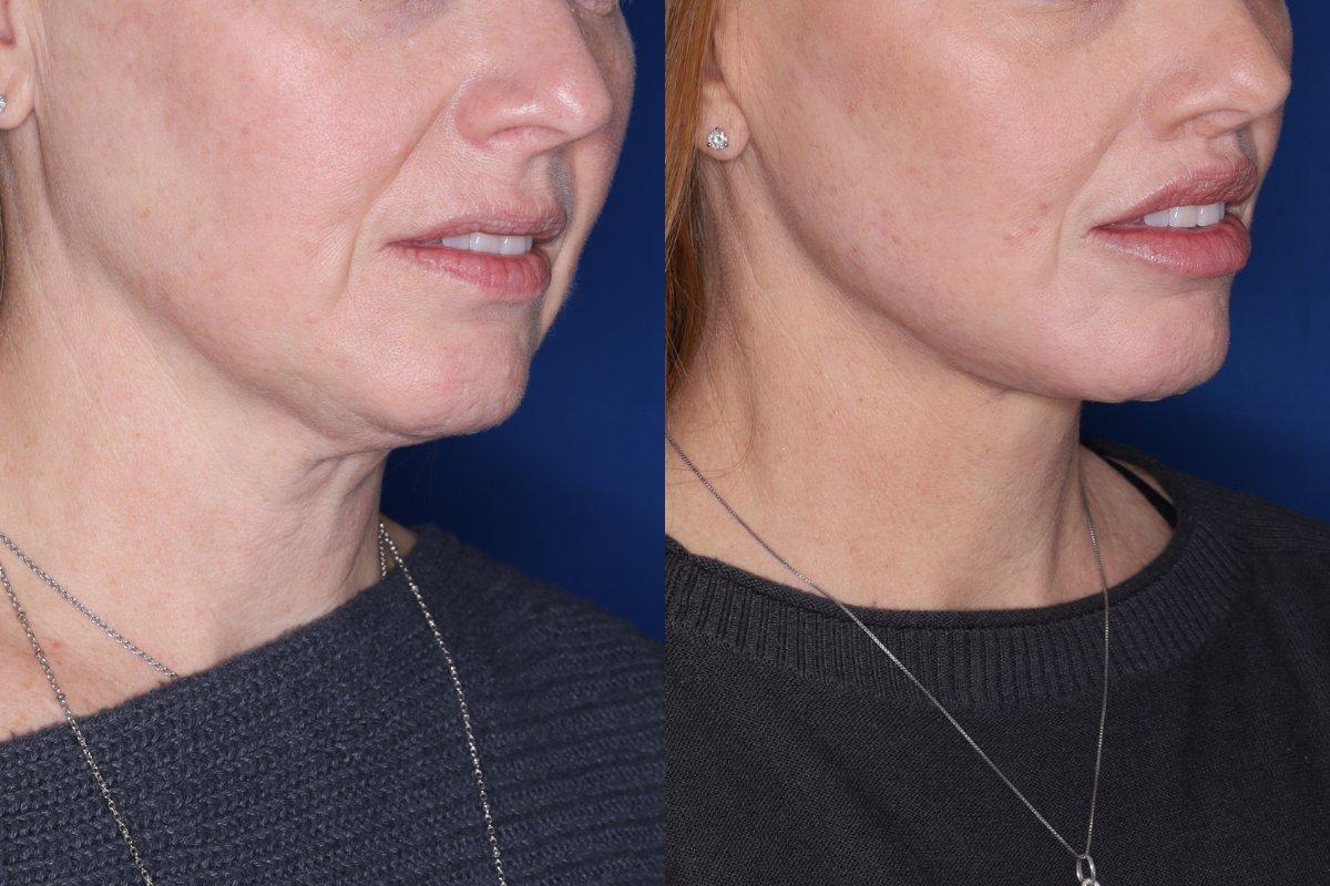 Kalos Facial Plastic Surgery facelift result — Alpharetta, GA