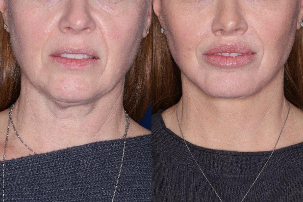 Kalos Facial Plastic Surgery facelift result — Alpharetta, GA