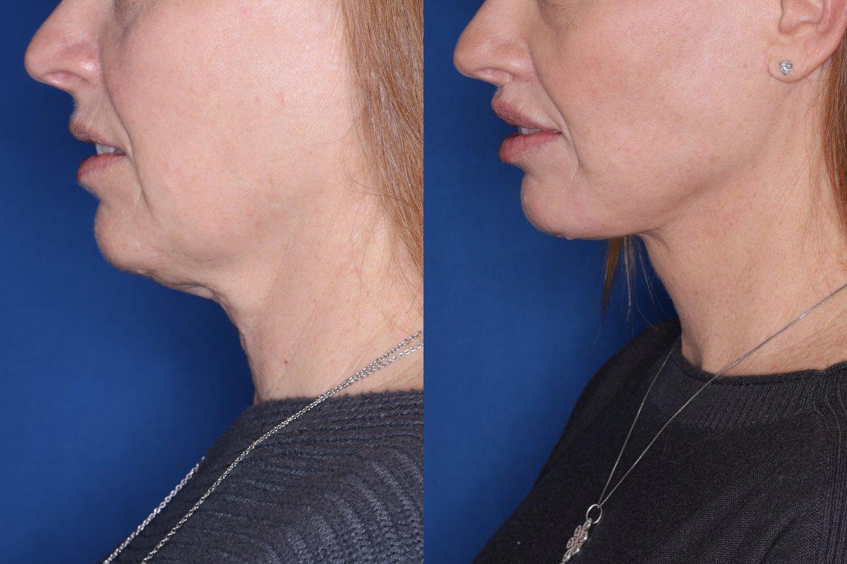 Kalos Facial Plastic Surgery facelift result — Alpharetta, GA