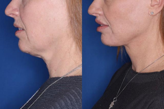 Facelift result at Kalos Facial Plastic Surgery in Alpharetta, GA